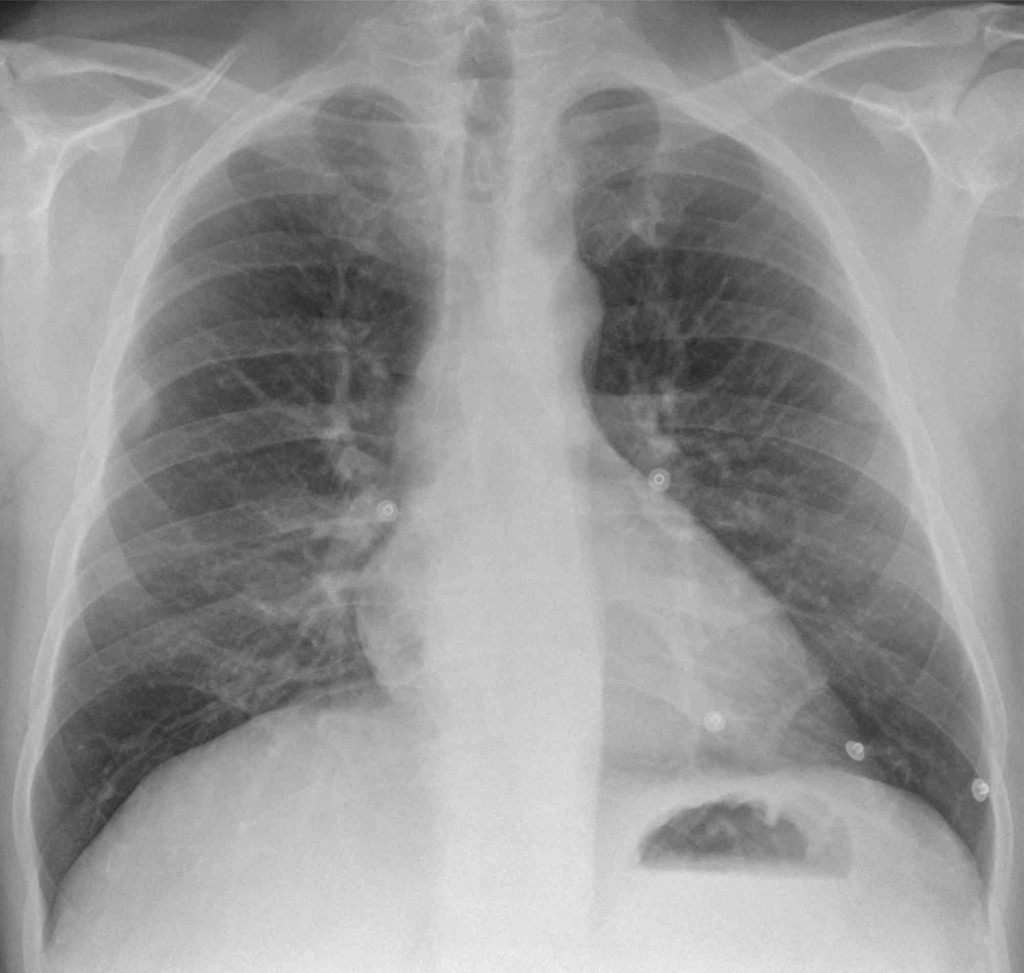 38-year-old man, PA chest