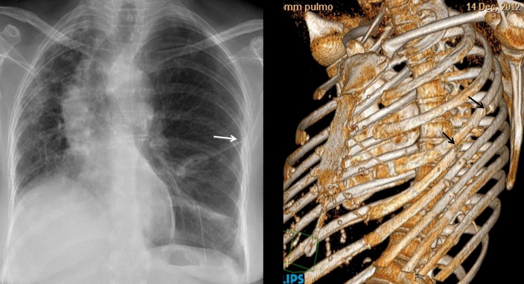 Fig. 2. Left lung transplant. Note post-surgical changes in the left 5th rib (arrows) 