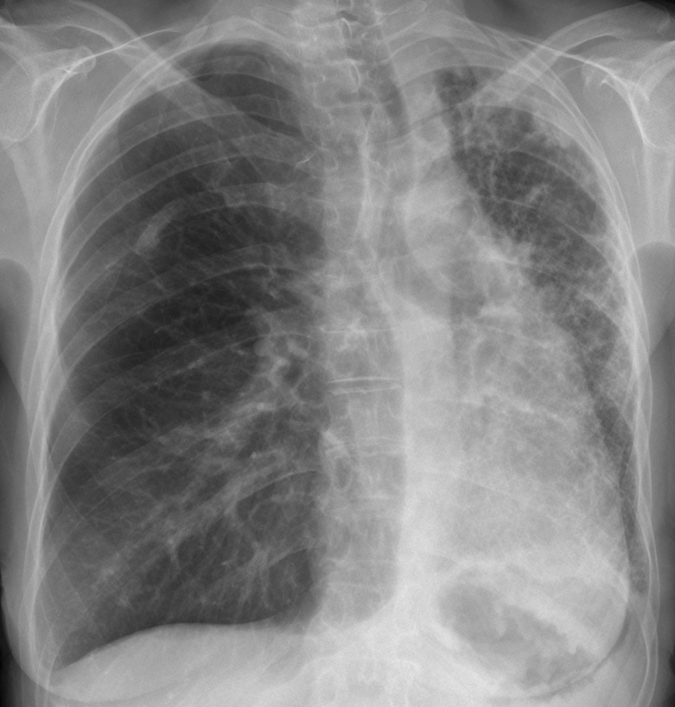 PA chest, 48-year-old woman