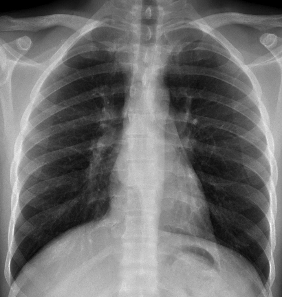 29-year-old, PA chest