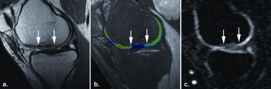 The sodium image of this patient (c) one year after autologous cartilage transplantation in the knee joint shows a low sodium SNR (the white arrows mark the border of the transplant), which corresponds to decreased GAG content of in the repaired tissue. This finding is confirmed by dGEMRIC another GAG specific technique (b). However the morphological image (a) with proton-density weighted FSE shows a good outcome with a good filling of the defect and a good integration of the repaired tissue. Copyright Radiology (with permission) 