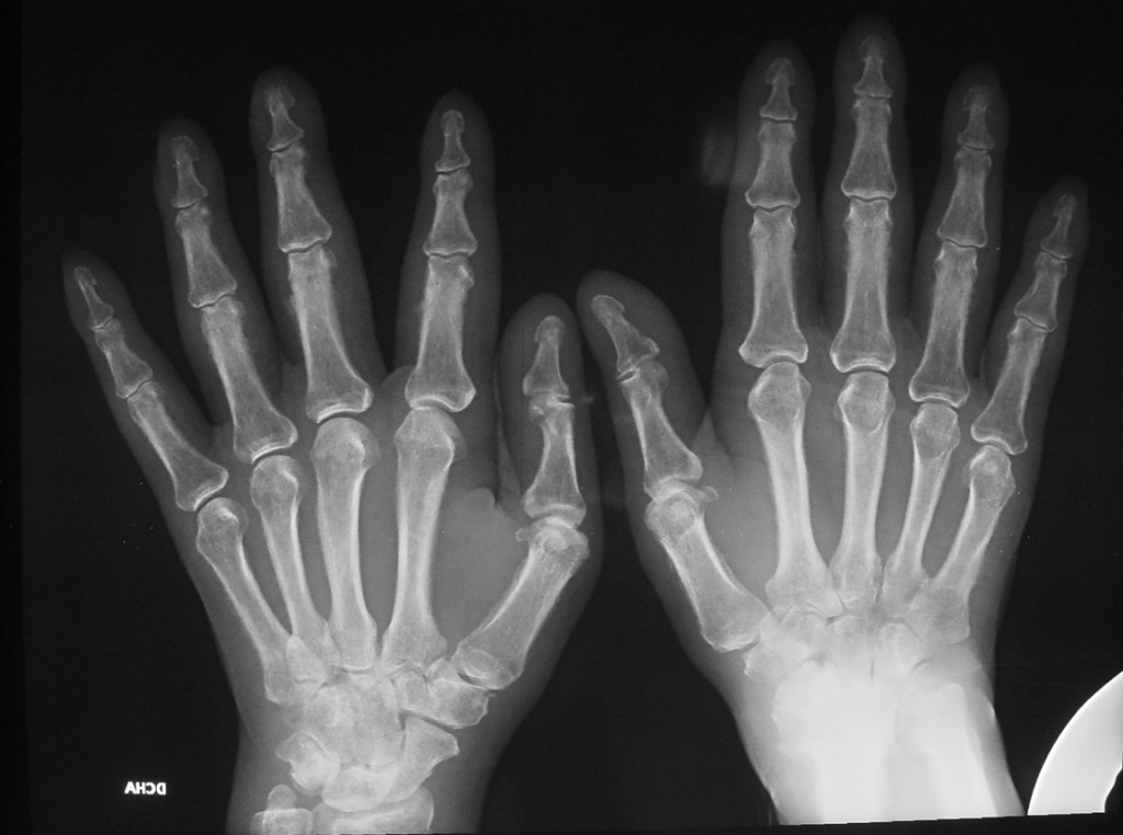 59-year-old male with pain in the joints (AP view)