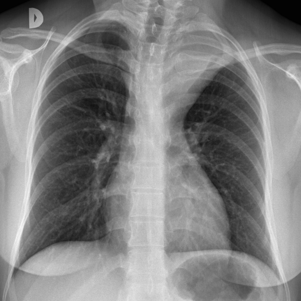 39-year-old woman, PA chest