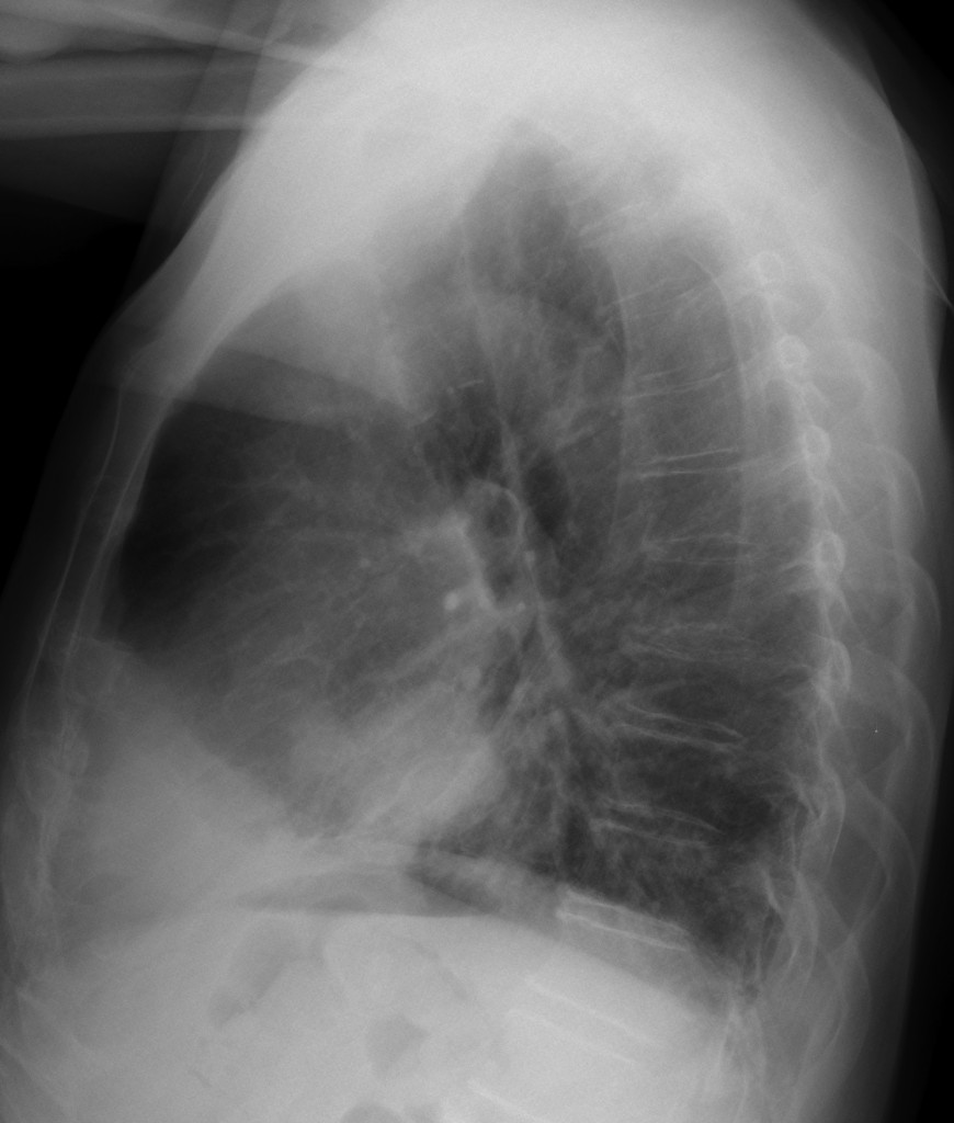 76 year-old male with two nodular lesions in lower lung fields (lateral)