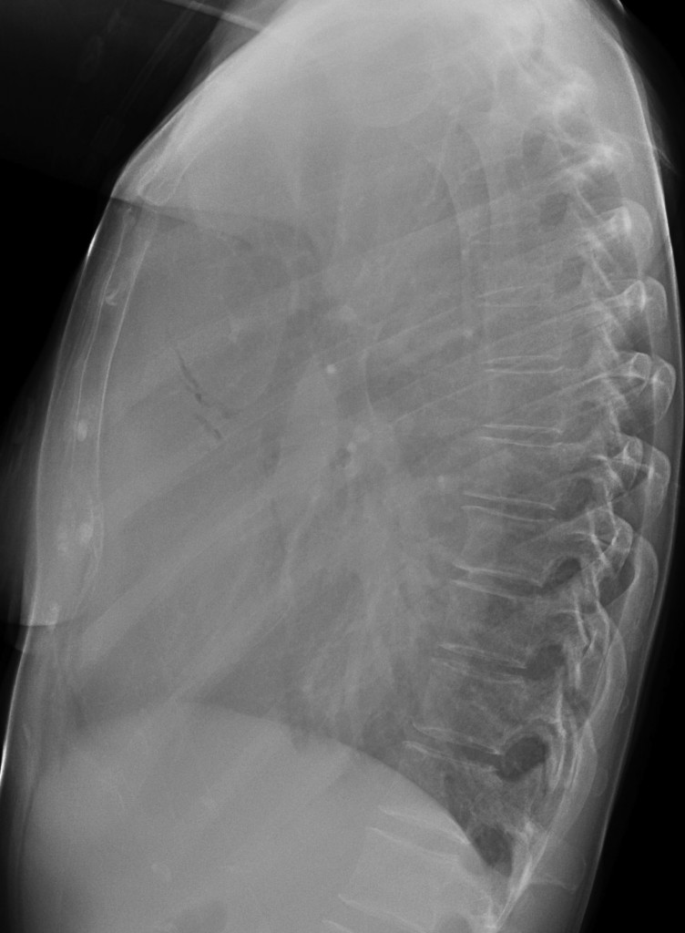 chest, 52 year old female (lateral)