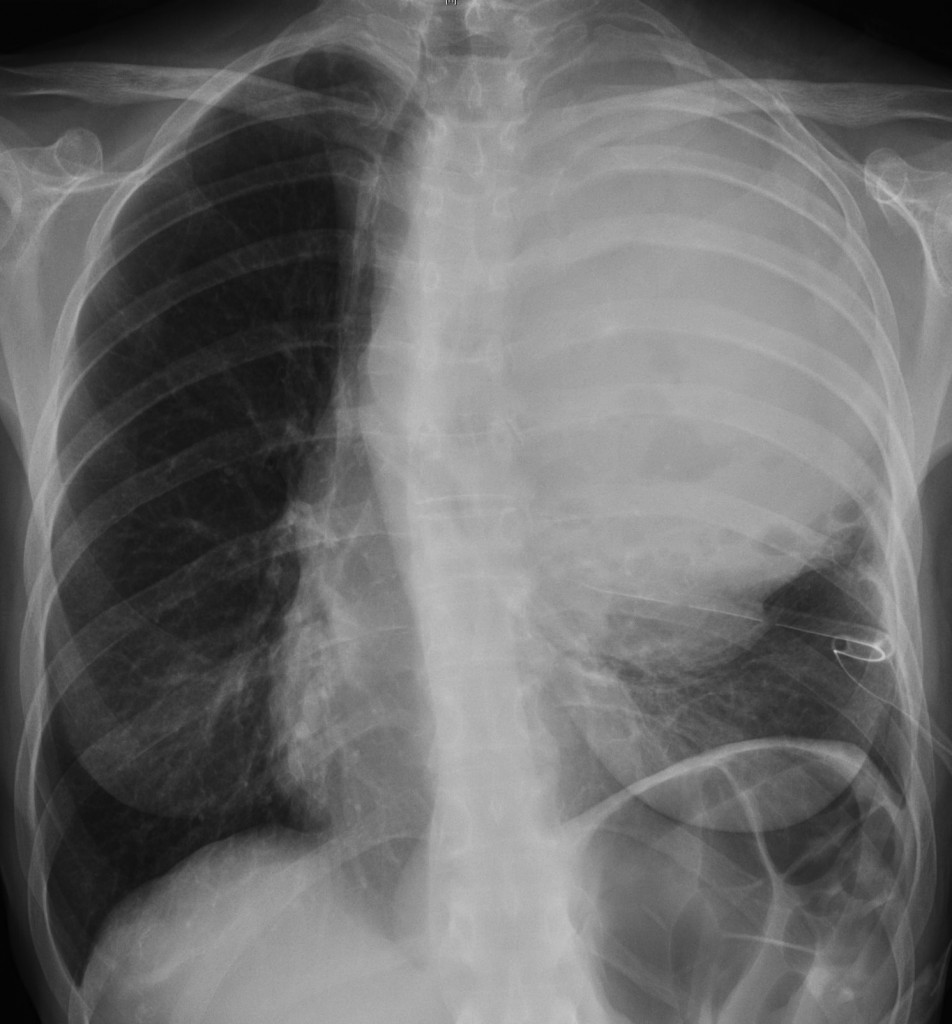 chest after thoracocentesis, 52 year old female (PA)