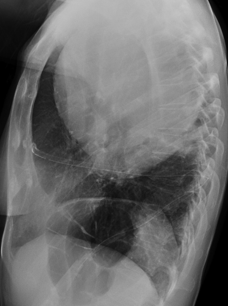 chest after thoracocentesis, 52 year old female (lateral)