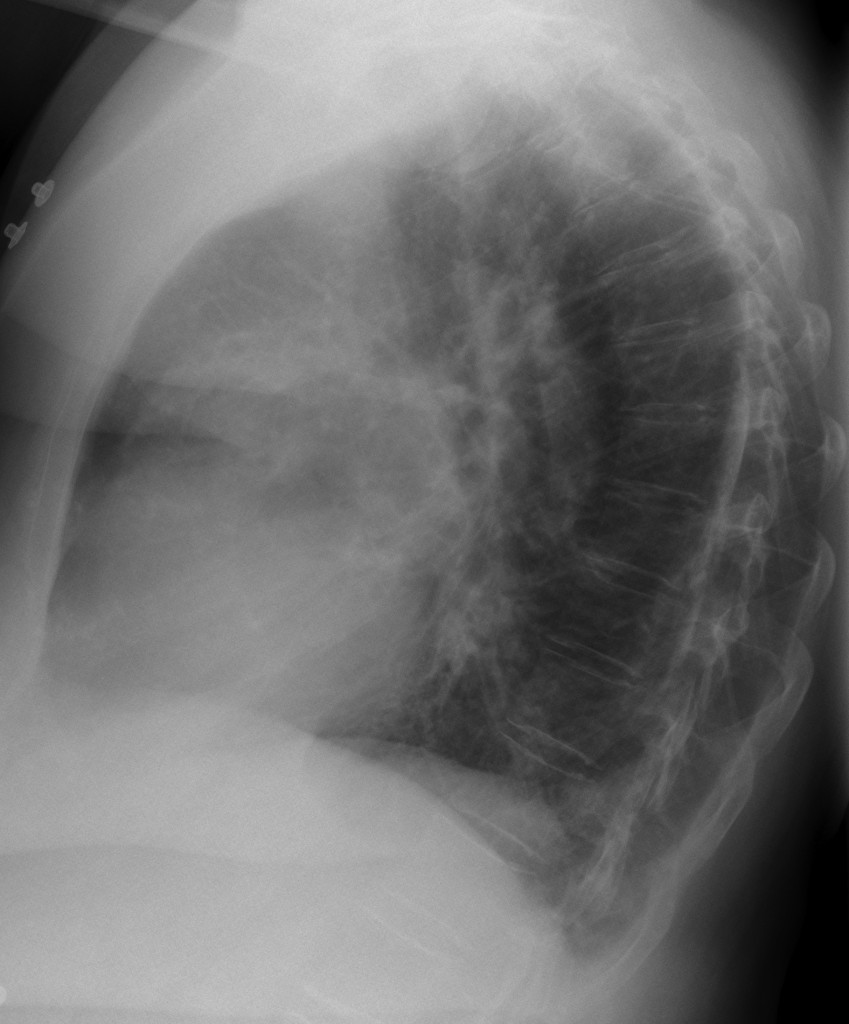 67 year old female, lateral chest