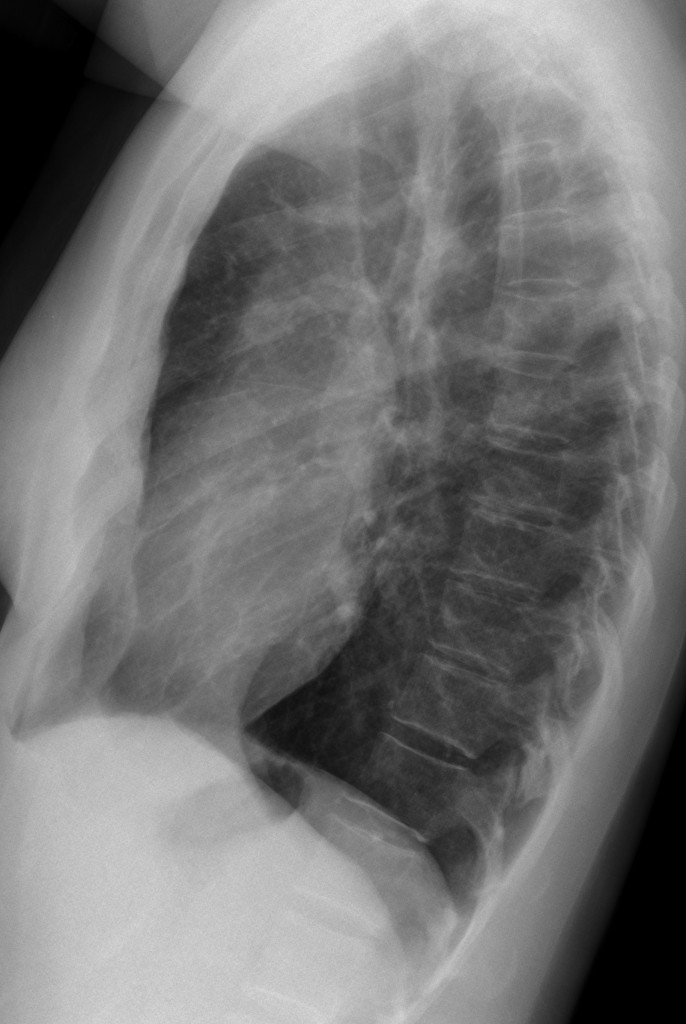40-year-old woman, lateral chest