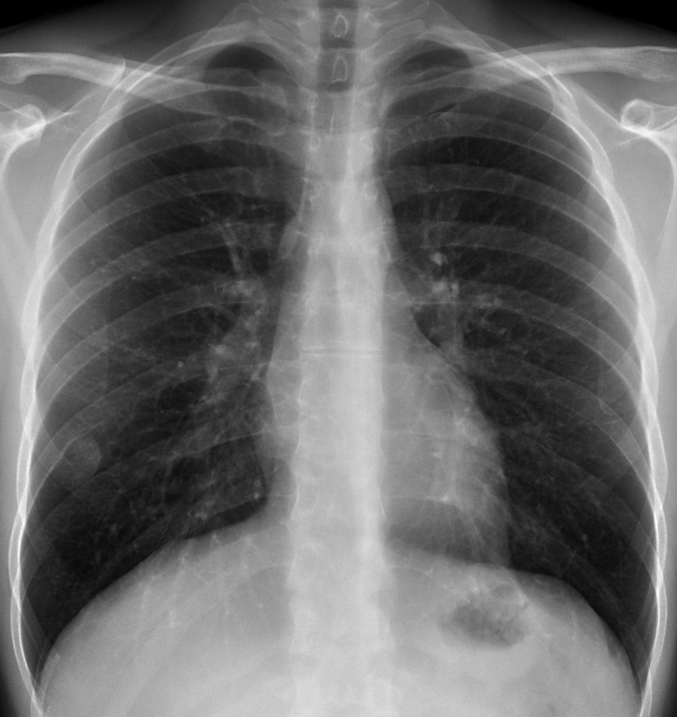 40 year-old man, PA chest