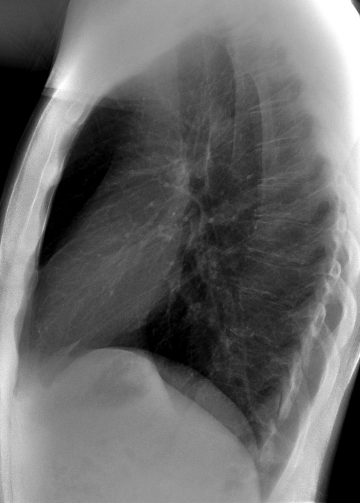 40 year-old man, lateral chest