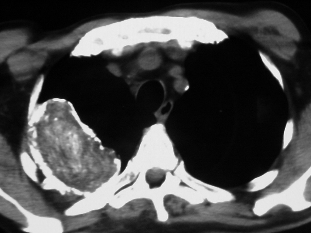 75-year-old male, CT