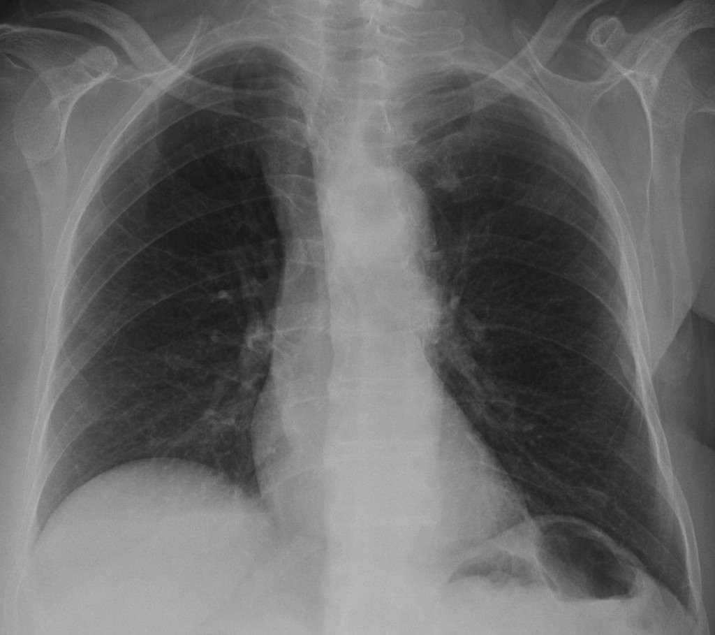 Seventy-five year-old woman, PA chest