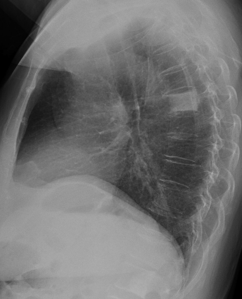 Seventy-five year-old woman, lateral chest