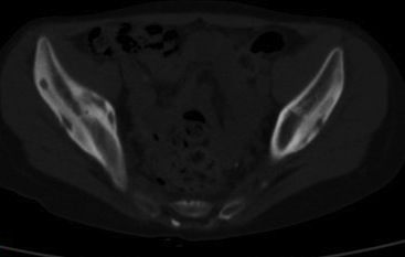11-year-old girl, axial CT
