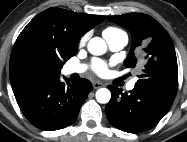 51-year-old male smoker, axial CT