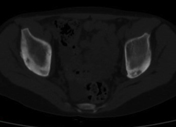 11-year-old girl, axial CT1