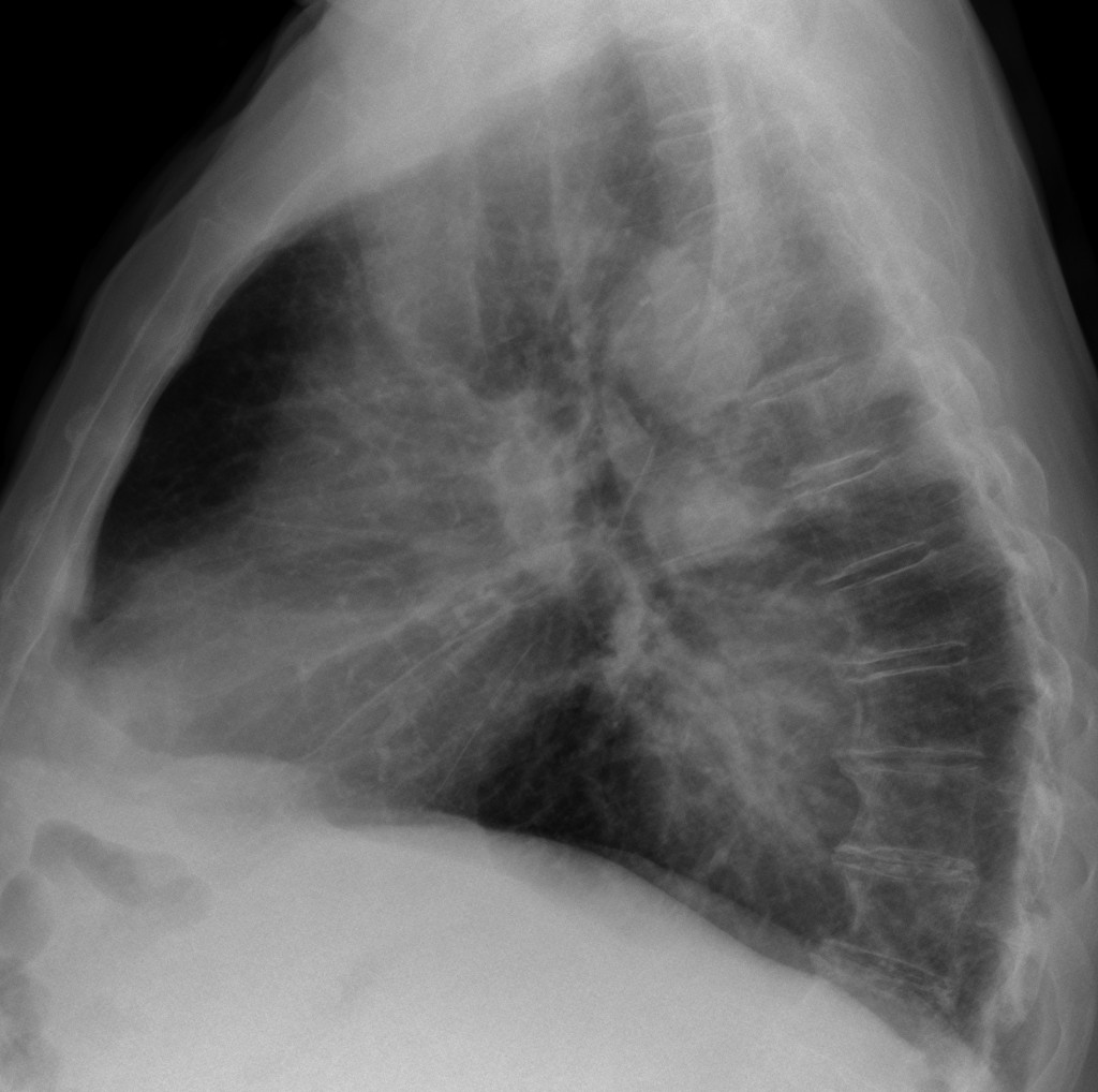 57-year-old male, erect lateral chest