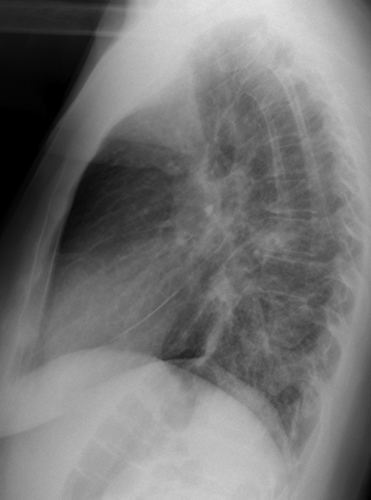49-year-old woman, lateral chest