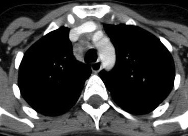 23-year-old woman, axial CT