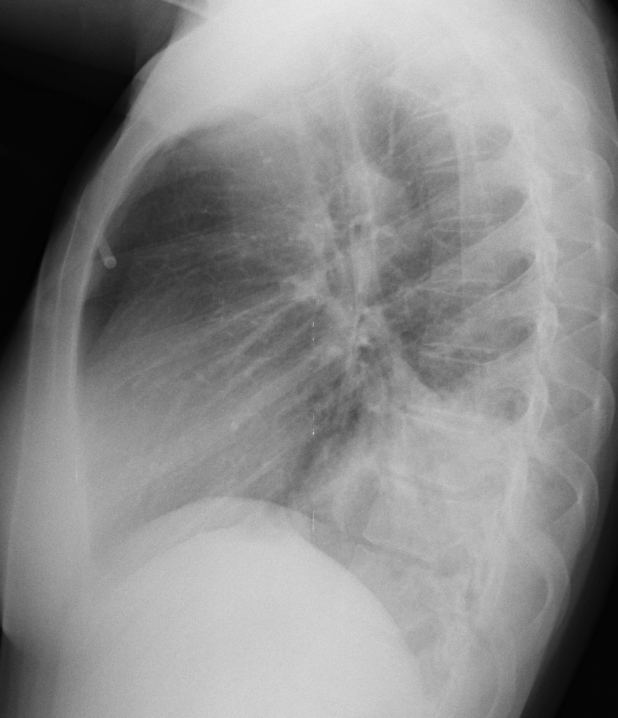 23-year-old woman, lateral chest