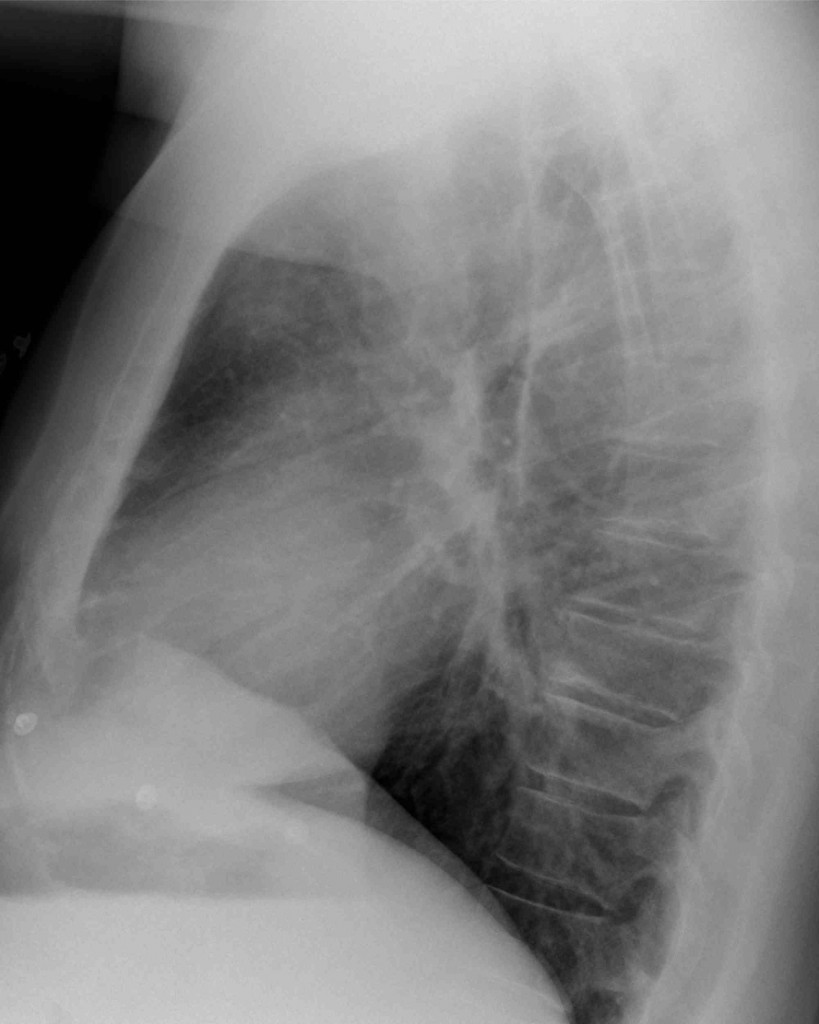 38-year-old man, lateral chest