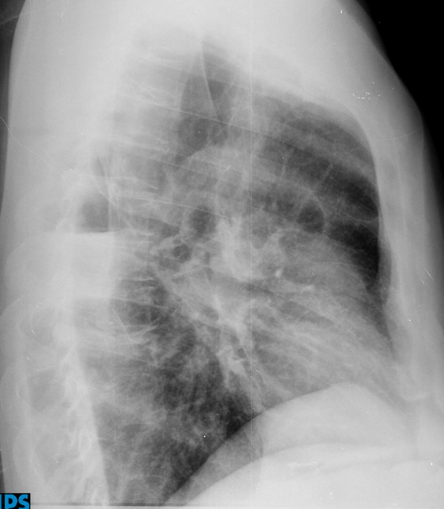 46-year-old man, lateral chest