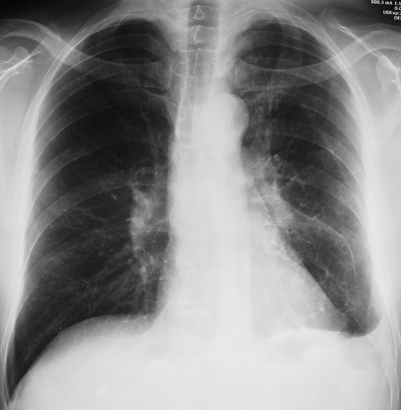 52-year-old man, PA chest