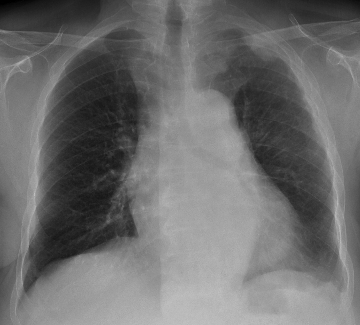 75-year-old woman, PA chest