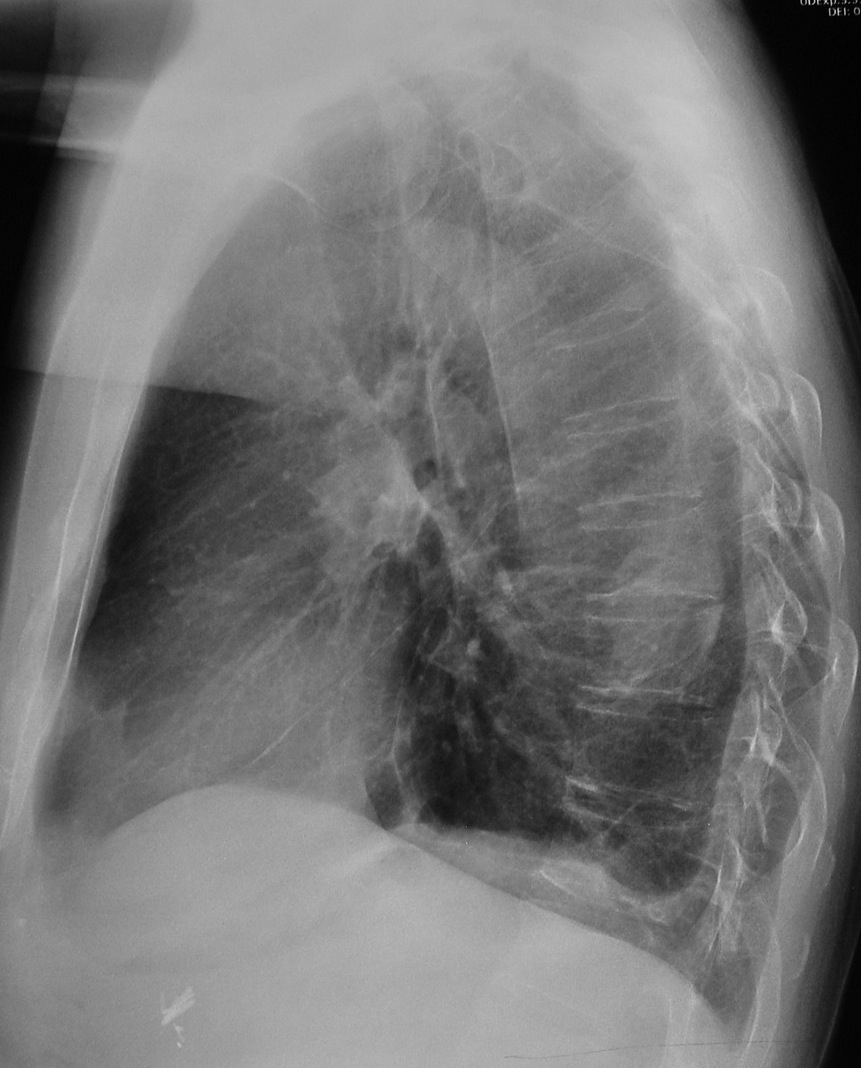 52-year-old man, lateral chest