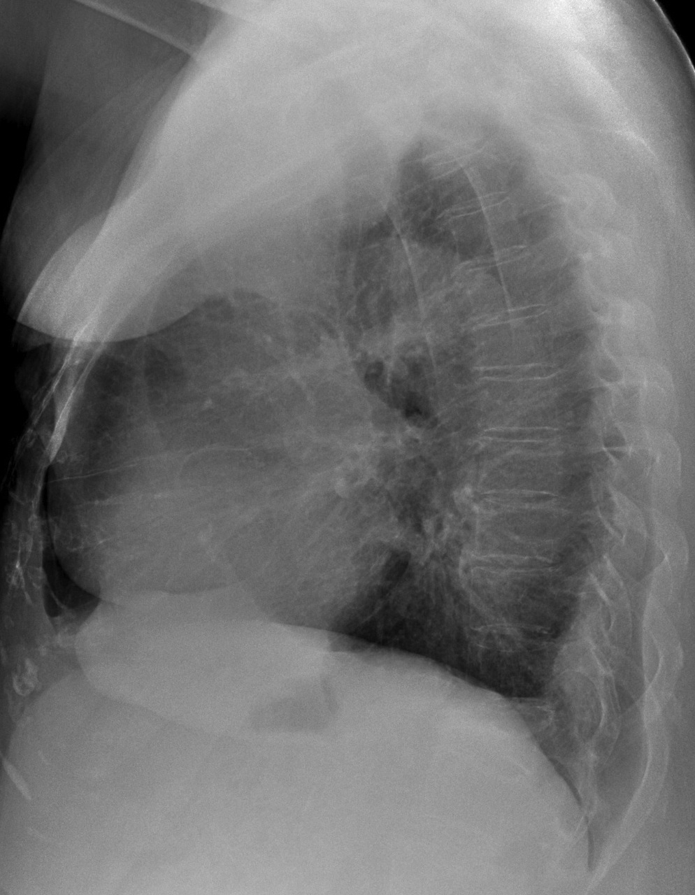75-year-old woman, lateral chest