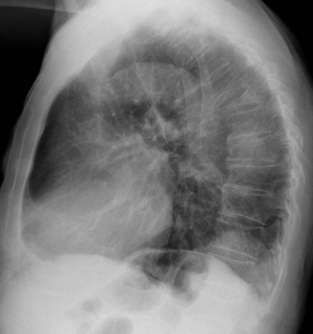 81-year-old male, lateral chest