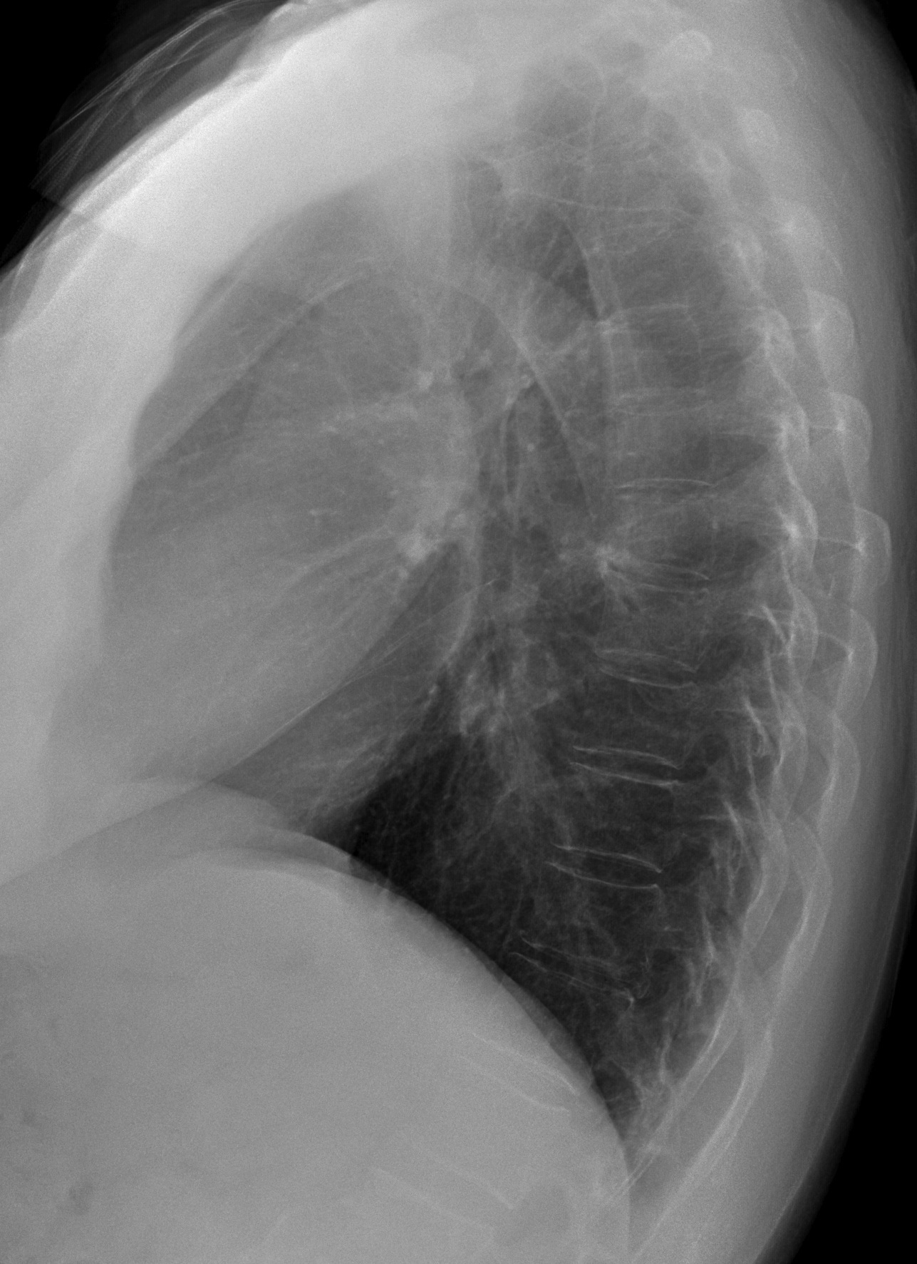 56-year-old female, lateral chest