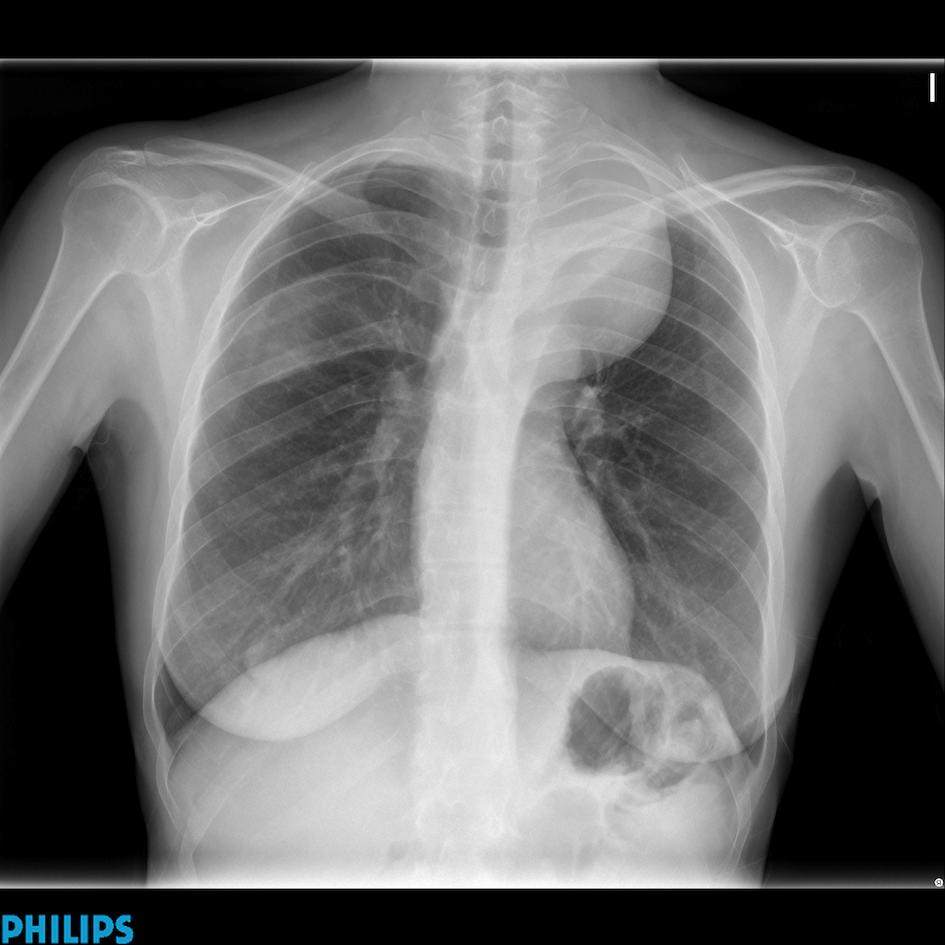 45-year-old woman, PA chest