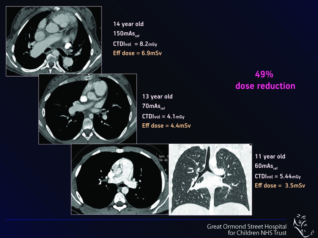 Paediatric MDCT  Chest Imaging Techniques