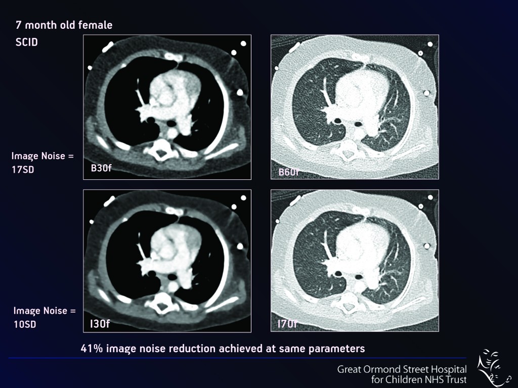 Paediatric MDCT  Chest Imaging Techniques