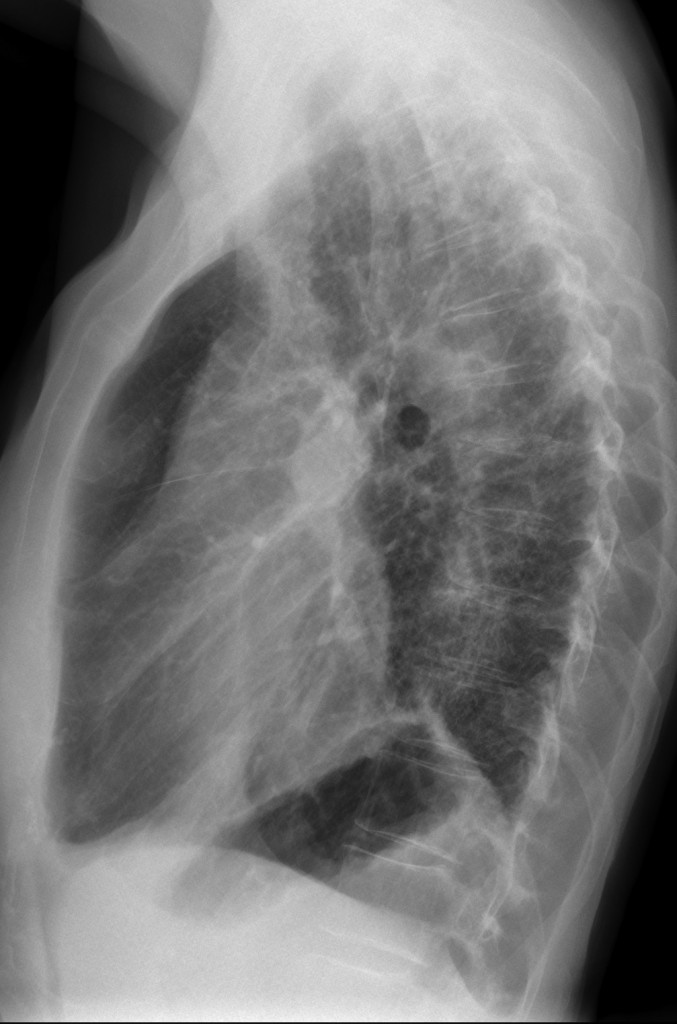 lateral chest, 48-year-old woman