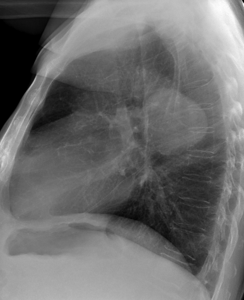 lateral chest, asymptomatic 67-year-old man