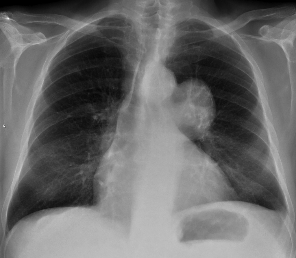 PA chest, asymptomatic 67-year-old man