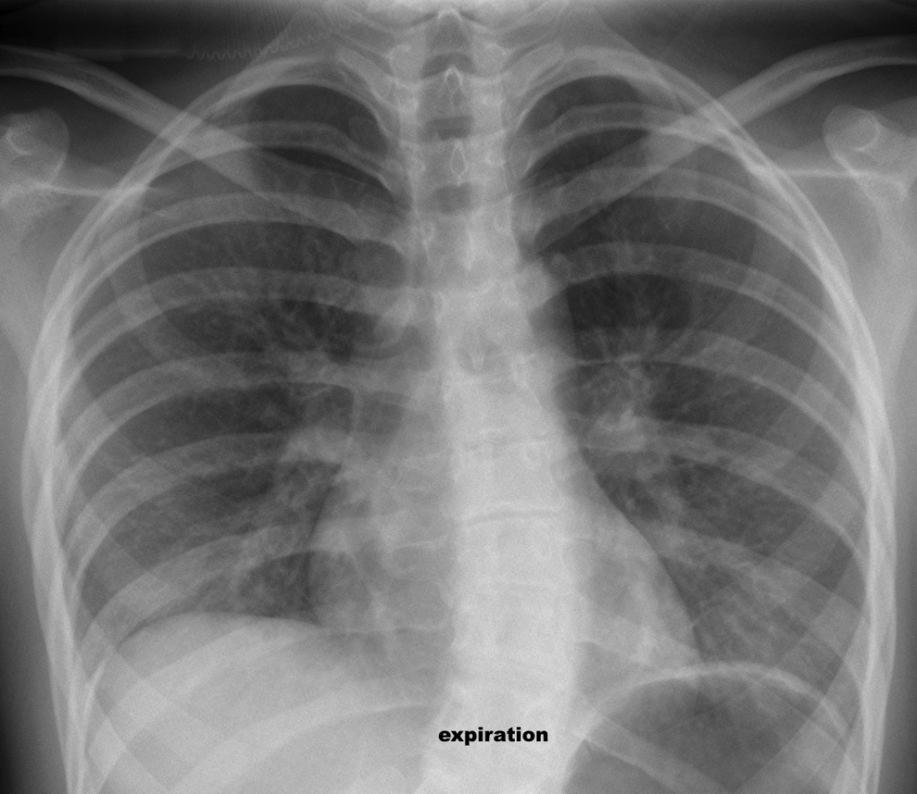 Expiration - 21-year-old girl with marked dyspnea, no fever.