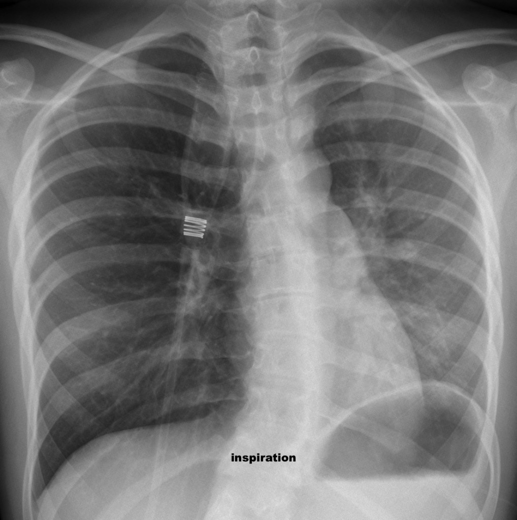 Inspiration - 21-year-old girl with marked dyspnea, no fever.