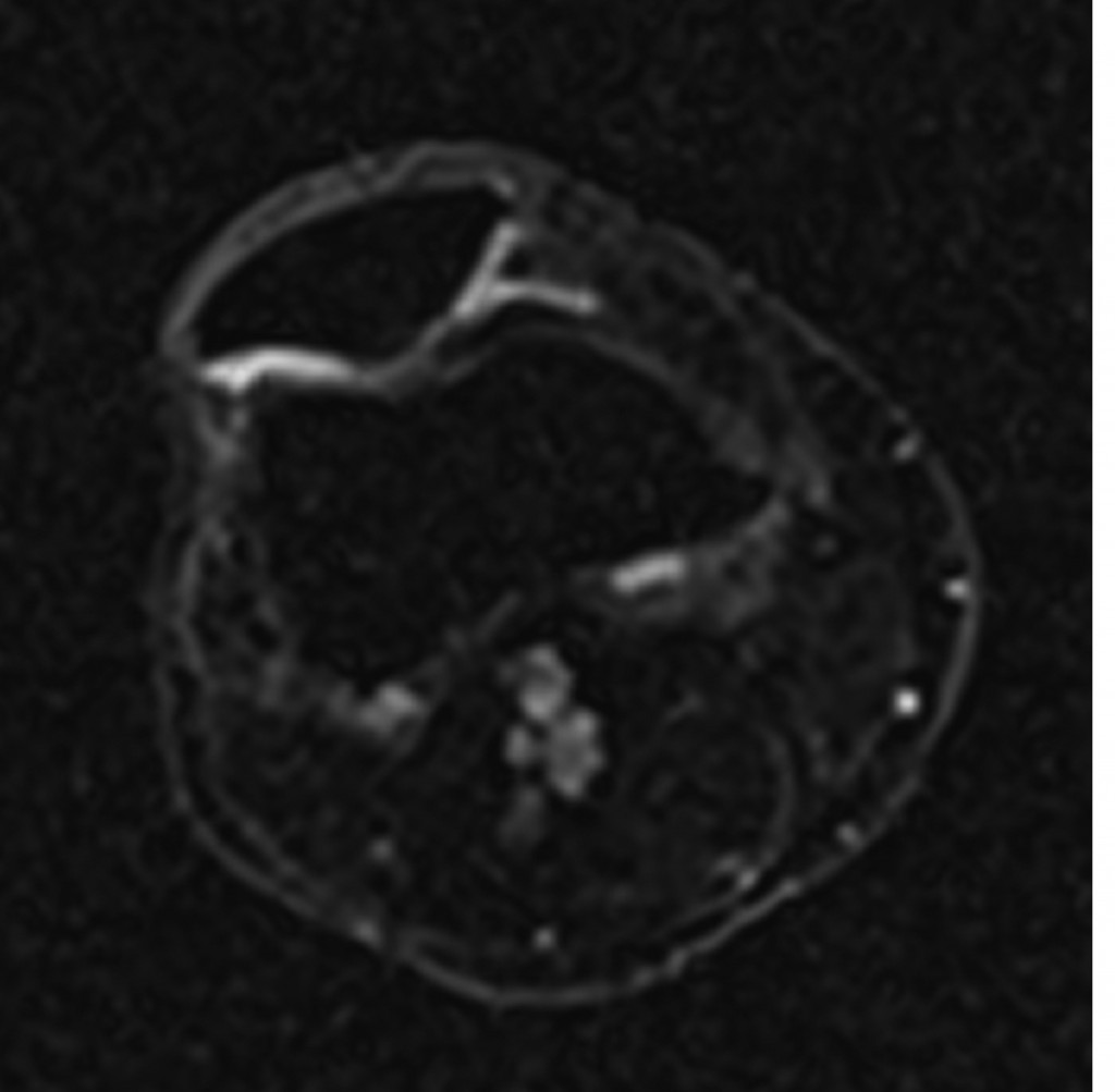 Sodium image in the axial plane of the patella shows the patellar cartilage. At the border from the medial to the lateral facet of the patella an area with decreased sodium signal-to-noise ratio (SNR) is visible which corresponds to a decreased content of glycosaminoglycan (GAG) although the cartilage thickness is preserved. This means an early stage of cartilage degeneration in this area with a focal loss of GAG. (Provided by Prof. Siegfried Trattnig and the MR Centre of Excellence) 