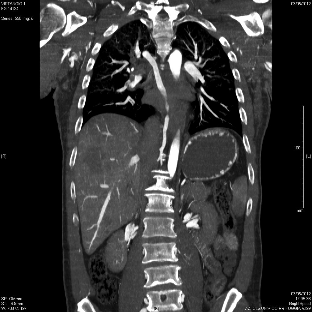 Post-mortem whole-body CT angiography. Pulmonary embolism: coronal multi planar reconstruction (MPR) showing the filling defect in the right descending branch of the pulmonary artery.
