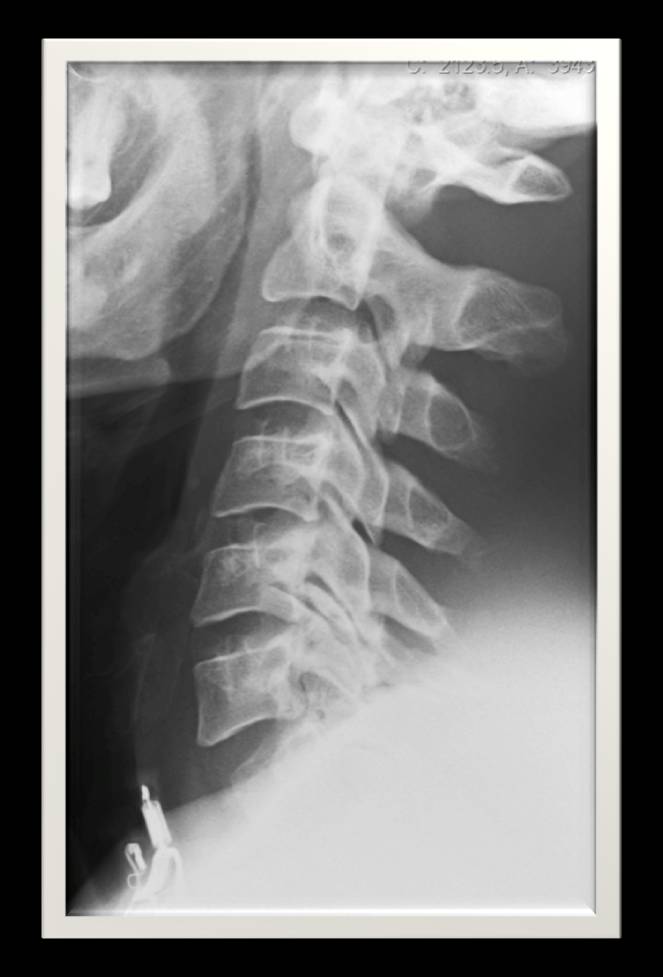 45-year-old man, lateral radiograph of cervical spine