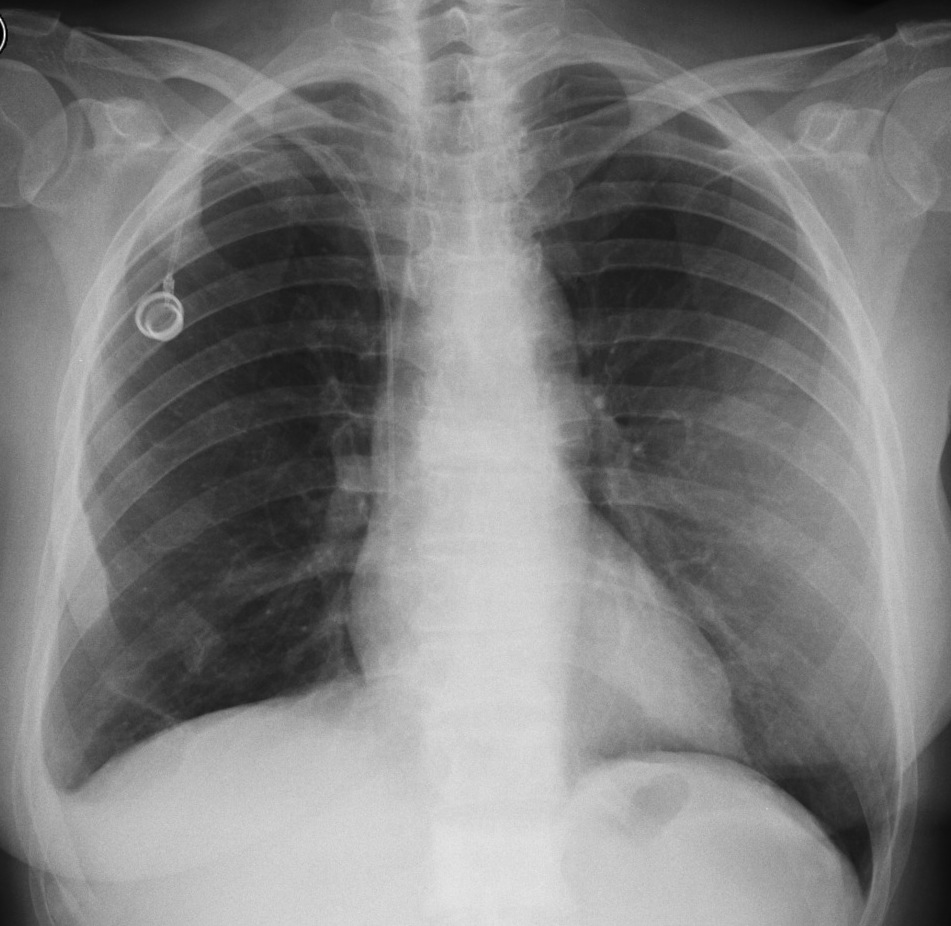 57-year-old woman, PA chest