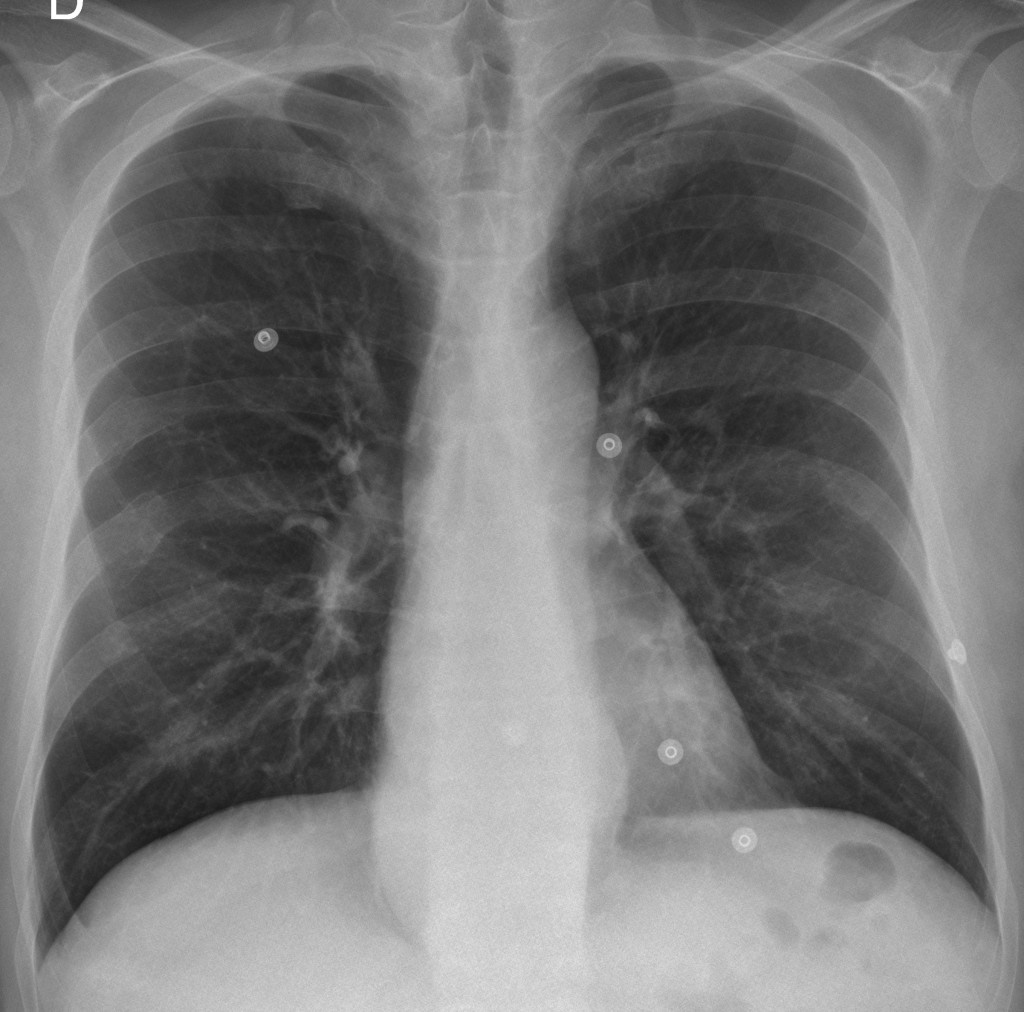 55-year-old man, PA chest
