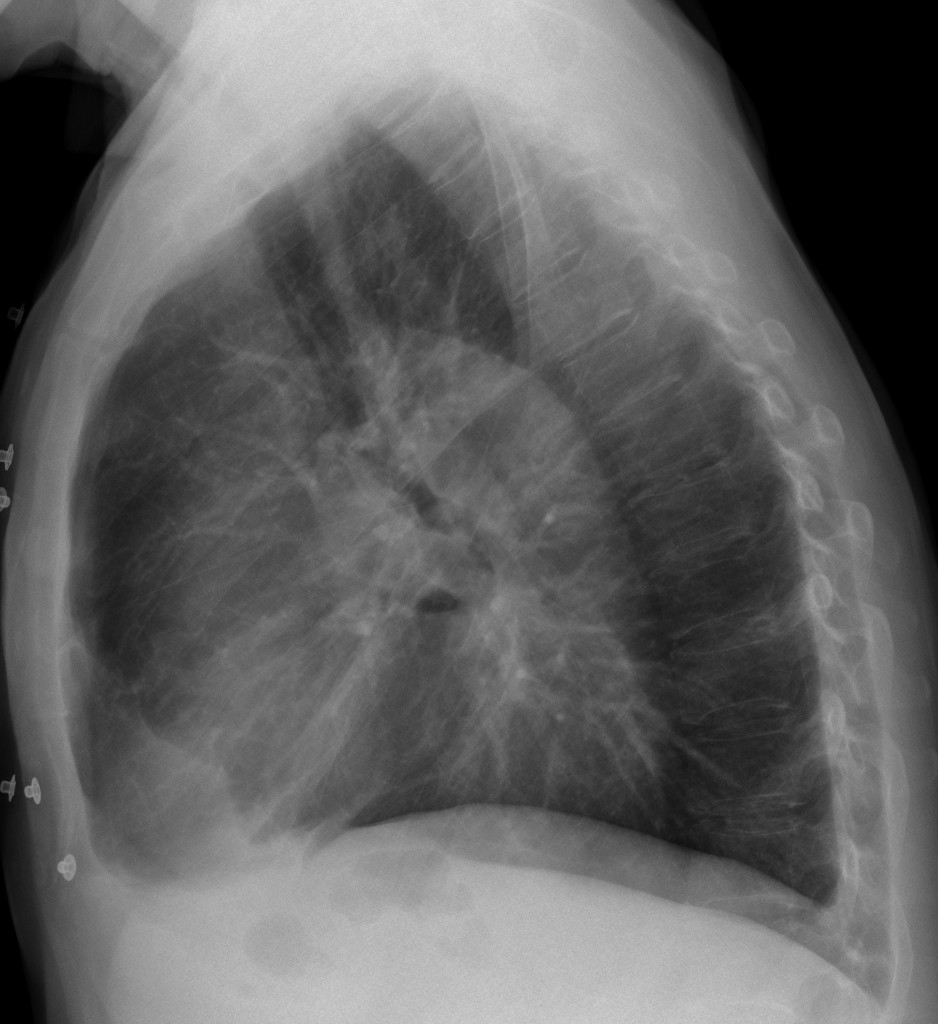 55-year-old man, lateral chest