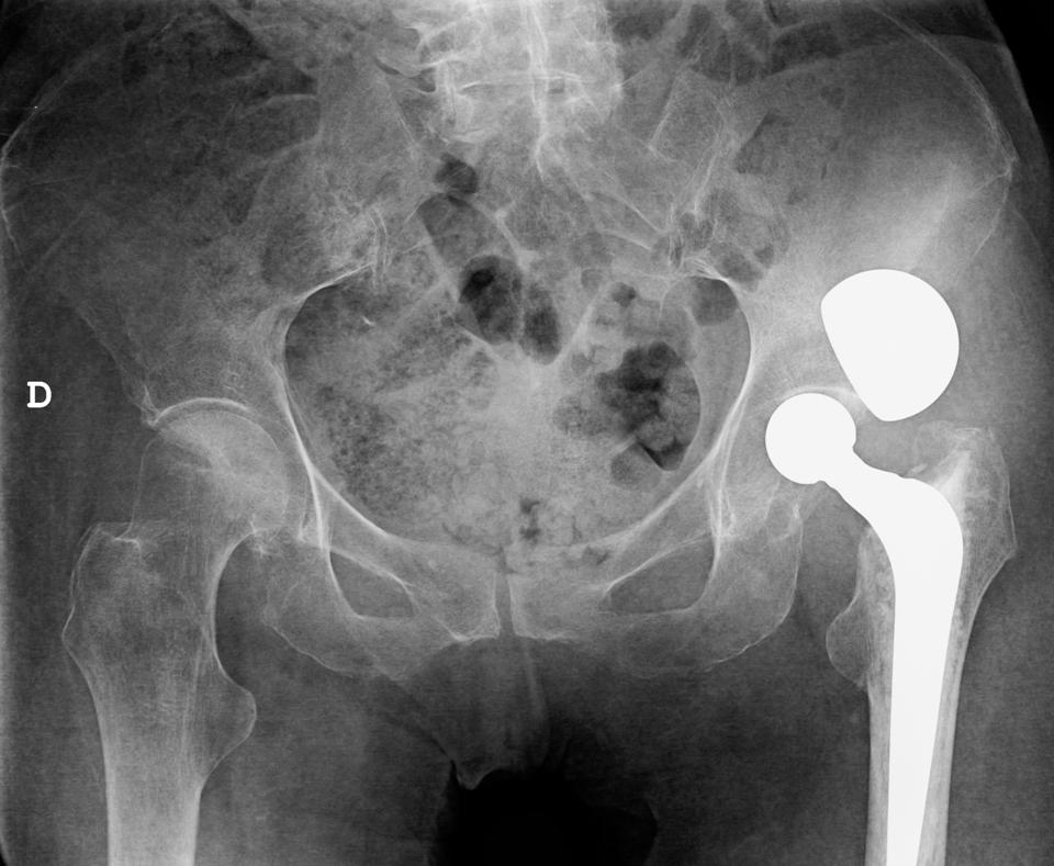 78-year-old woman after close reduction of a dislocated hip prosthesis
