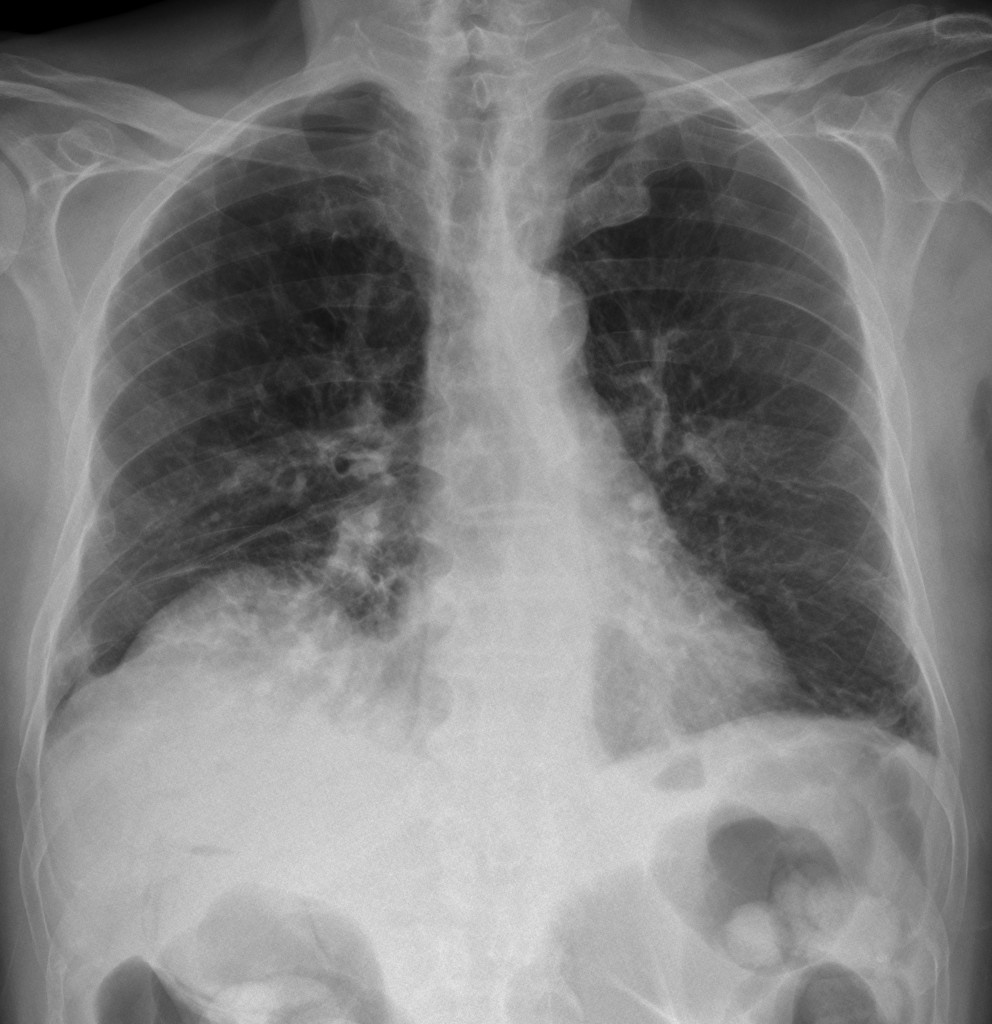 80-year-old male, PA chest