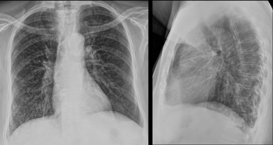 57-year-old woman with a chronic cough and mild fever who also suffered from TB in the past.